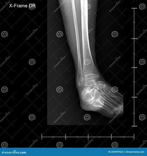 X-ray Tarsal and Ankle Front. Stock Image - Image of lateral ...