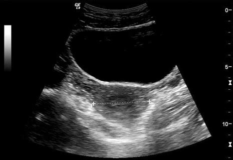 Introduction to Point of Care Urinary Bladder Ultrasound | Point-of-Care Ultrasound ...