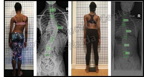 Scoliosis Treatment Results - See Before and After Pictures