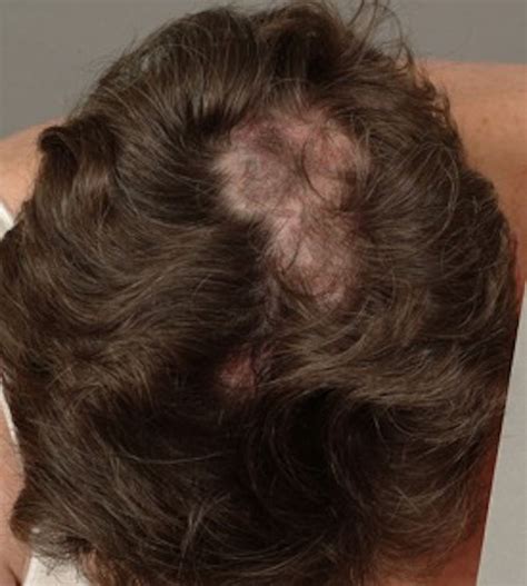 Alopecias in lupus erythematosus | Lupus Science & Medicine