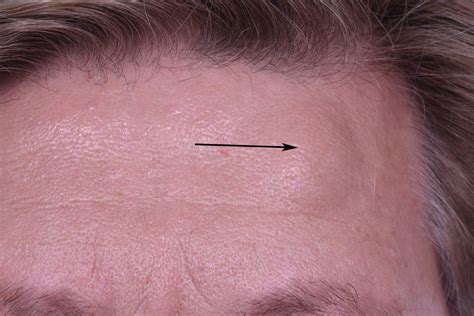 Forehead: Osteoma / Lipoma - Dr. Gassner