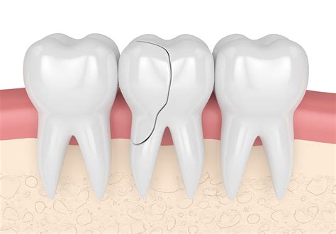 Ways to Repair Broken or Cracked Tooth - Ascent Family Dental