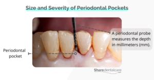 Periodontal Pocket Symptoms - Share Dental Care