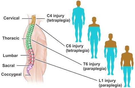 Cervical spinal cord injury treatment