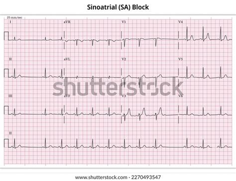 Sinoatrial Sa Block Ecg Paper 12 Stock Vector (Royalty Free) 2270493547 ...