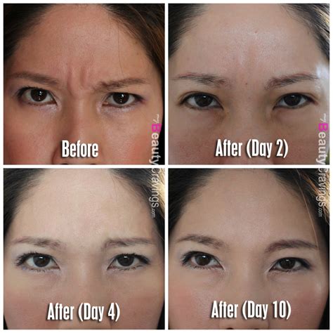 Botox Review at Cutis Medical Laser Clinics | $208 to get rid of Forehead Wrinkles ...