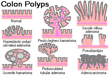 colonpol.gif (360×240) | Colon, Polyp, Colon cleanse