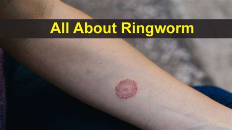 All About Ringworm: Causes, Symptoms, Risk Factors, Diagnosis, Treatments And Prevention ...