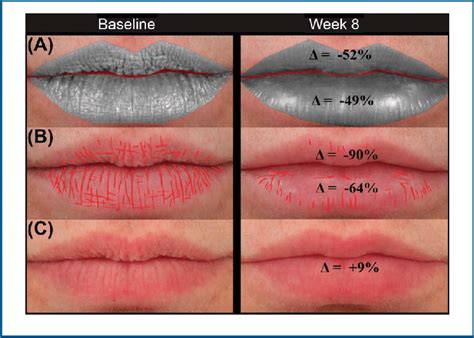 Lip texture of a 51-year-old subject treated with 0.9 mL and 0.55 mL HA... | Download Scientific ...