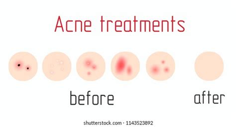 Acne Treatment Diagram Illustration Vector On Stock Vector (Royalty ...