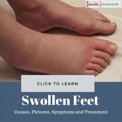 Swollen Feet : Causes, Pictures, Symptoms And Treatment