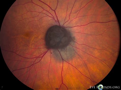 Atlas Entry - Melanocytoma with associated choroidal nevus