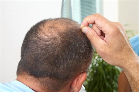 Tips For Coping With Hair Loss Caused By Scalp Psoriasis - Hair Loss ...