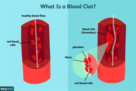 Blood Clot Blocks Blood Flow - Anatomicum