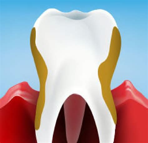 Periodontitis: Symptoms, Causes, and Treatments - Crest