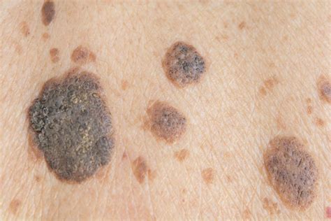 SEBORRHEIC KERATOSIS – Dermatology Conditions and Treatments