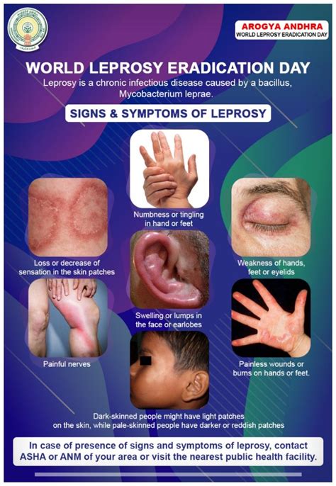 World Leprosy Day: Early symptoms of leprosy in children...