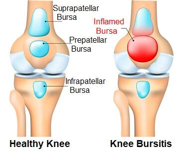 Knee Bursitis: Symptoms, Diagnosis & Treatment - Knee Pain Explained