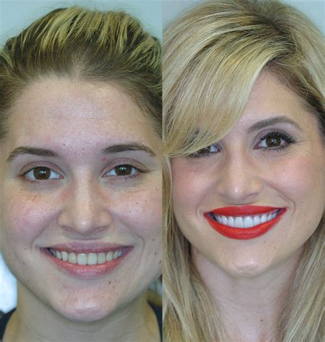 Before & After Porcelain Veneers - Cosmetic Dentists of Houston- Cosmetic Dentist- General Dentistry