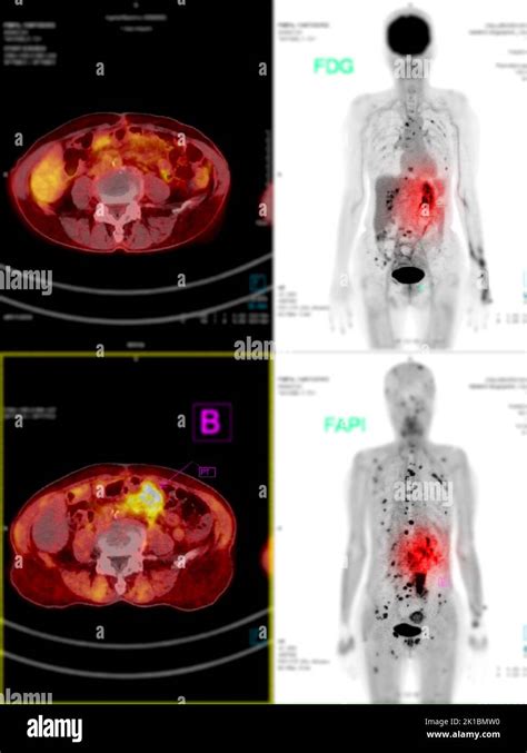 Positron emission tomography (PET) CT scan uses a radioactive drug (tracer) to show both normal ...