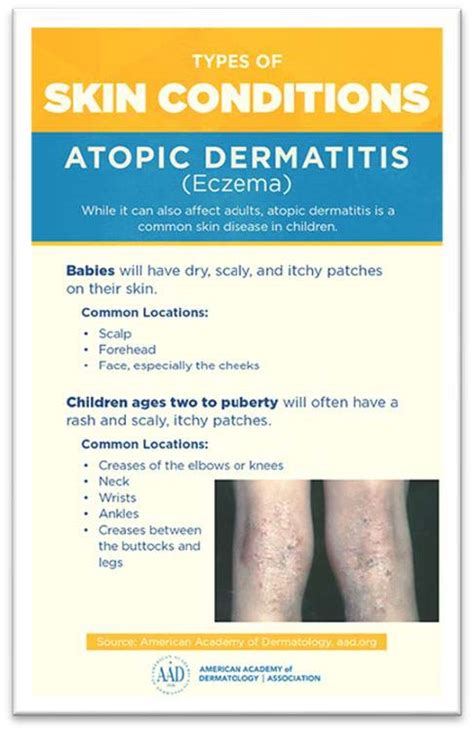 Atopic Dermatitis/Eczema: Diagnosis and Treatment - Dermatology Surgery Center - Niceville, FL ...