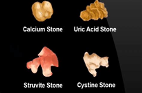 Uric Acid Kidney Stones