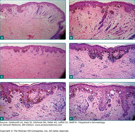 Dysplastic Nevus Histology