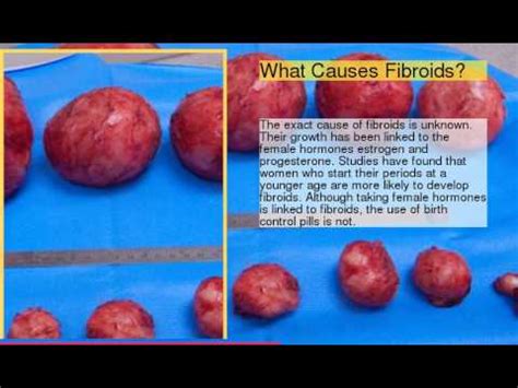 uterine fibroid size chart Comparing fibroids with fruits