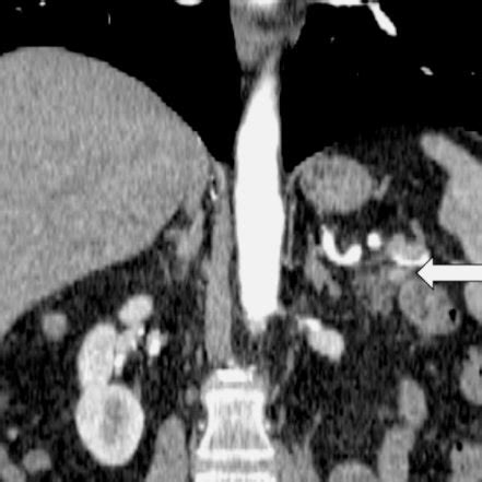 (PDF) Intrapancreatic accessory spleen