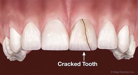 Tooth Extraction | Fall Creek Dental | Granbury Texas