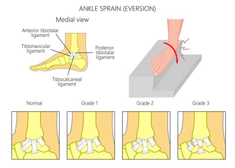 Deltoid Ligament Sprain | How to Treat a Sprain of the Deltoid Ligament