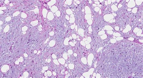 Hamartoma of the lung | Atlas of Pathology