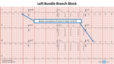 Bundle Branch Block Archives - teachIM