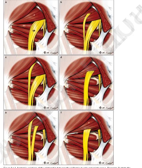 Sciatic Nerve Entrapment At The Deep Gluteal Space Posterior Hip – Themeloader