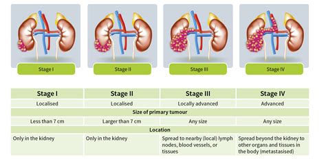 Images/Graphics Kidney Cancer - IKCC - International Kidney Cancer Coalition