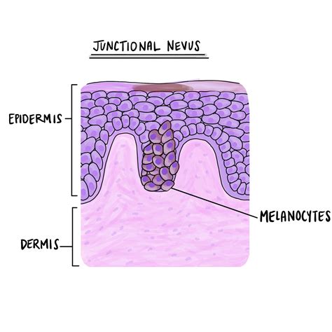 Is a junctional nevus cancerous?