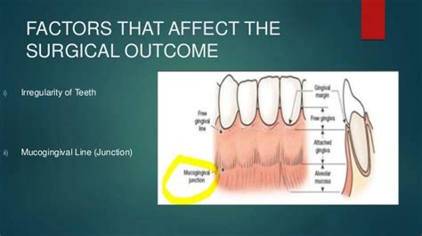 Mucogingival surgery in periodontics