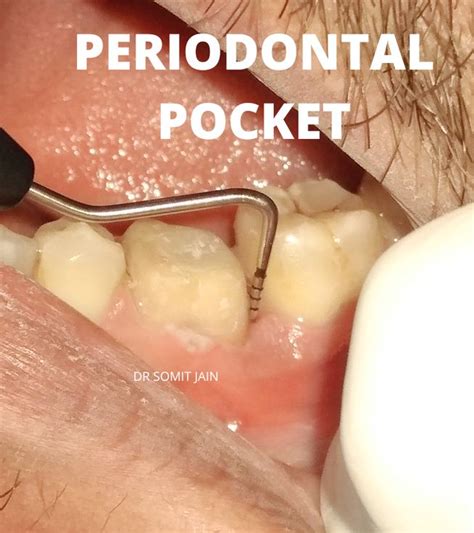 THE PERIODONTAL POCKET - Prestige Dental Care