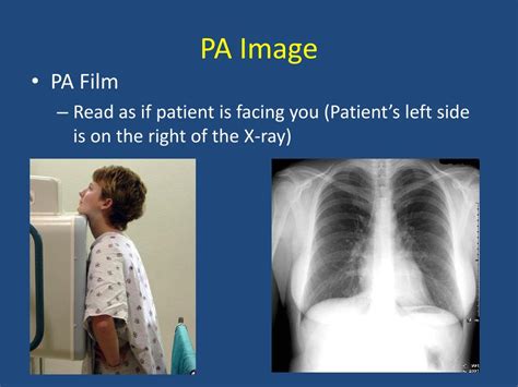 PPT - Basics of Chest X-Ray PowerPoint Presentation, free download - ID:3620583