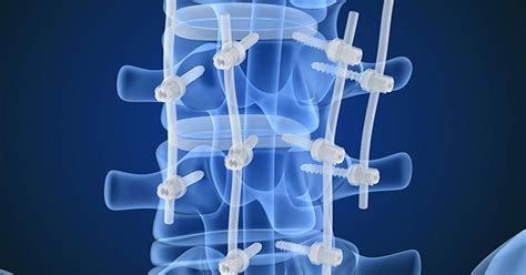 Posterior Lumbar Interbody Fusion (PLIF) - Atlanta, GA - Spine Surgery