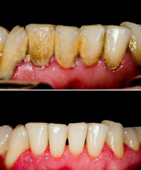 Periodontal Disease - Stages of Periodontal Disease - Before and After