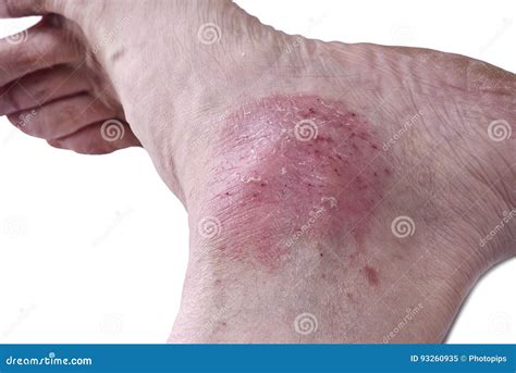 Psoriasis, Skin Disease Royalty-Free Stock Image | CartoonDealer.com #93260614