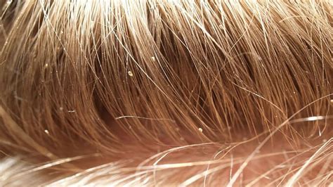 Head Lice Treatment Eggs at Jose Lopez blog