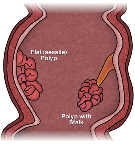 Colon cancer bleeding frequency - Macaroni22