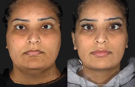 Mole Removal Before & After Photos in Kelowna, BC | DermMedica