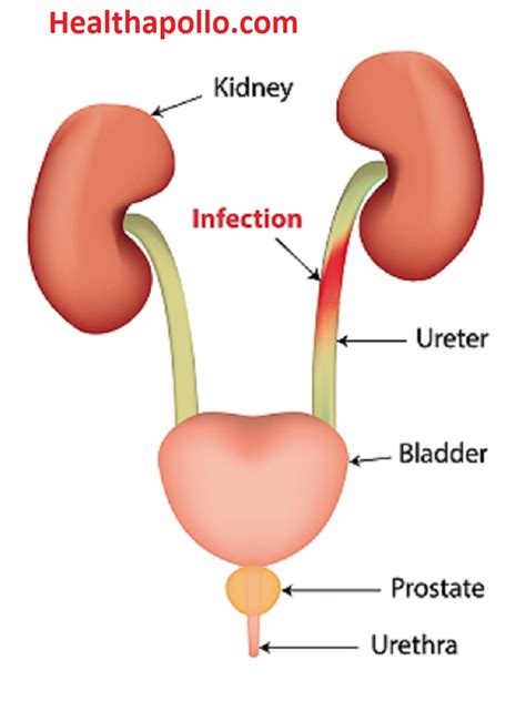 UTI ( Urinary Tract Infection) Causes, Symptoms and Home remedies