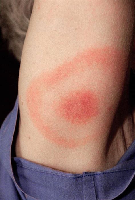 Tick Bite - Pictures, Symptoms, Removal, Treatment | Deer Tick Bite | Diseases Pictures