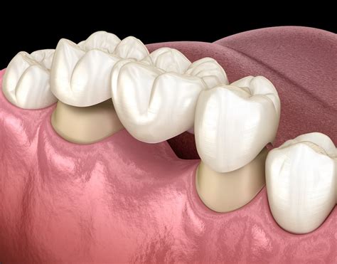 6 Real-World Dental Implant Alternatives (2024 Update)