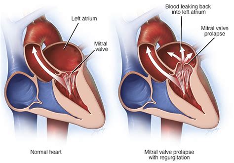 Mitral Valve Prolapse - Causes, Symptoms, Diagnosis, Treatment