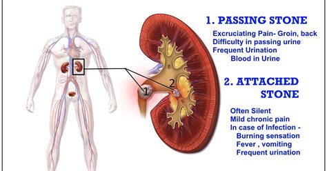 Medicine Health And You: Kidney Stone Symptoms